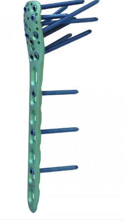 Проксимально плечова пластина І ( Double Medical Technology Inc.)